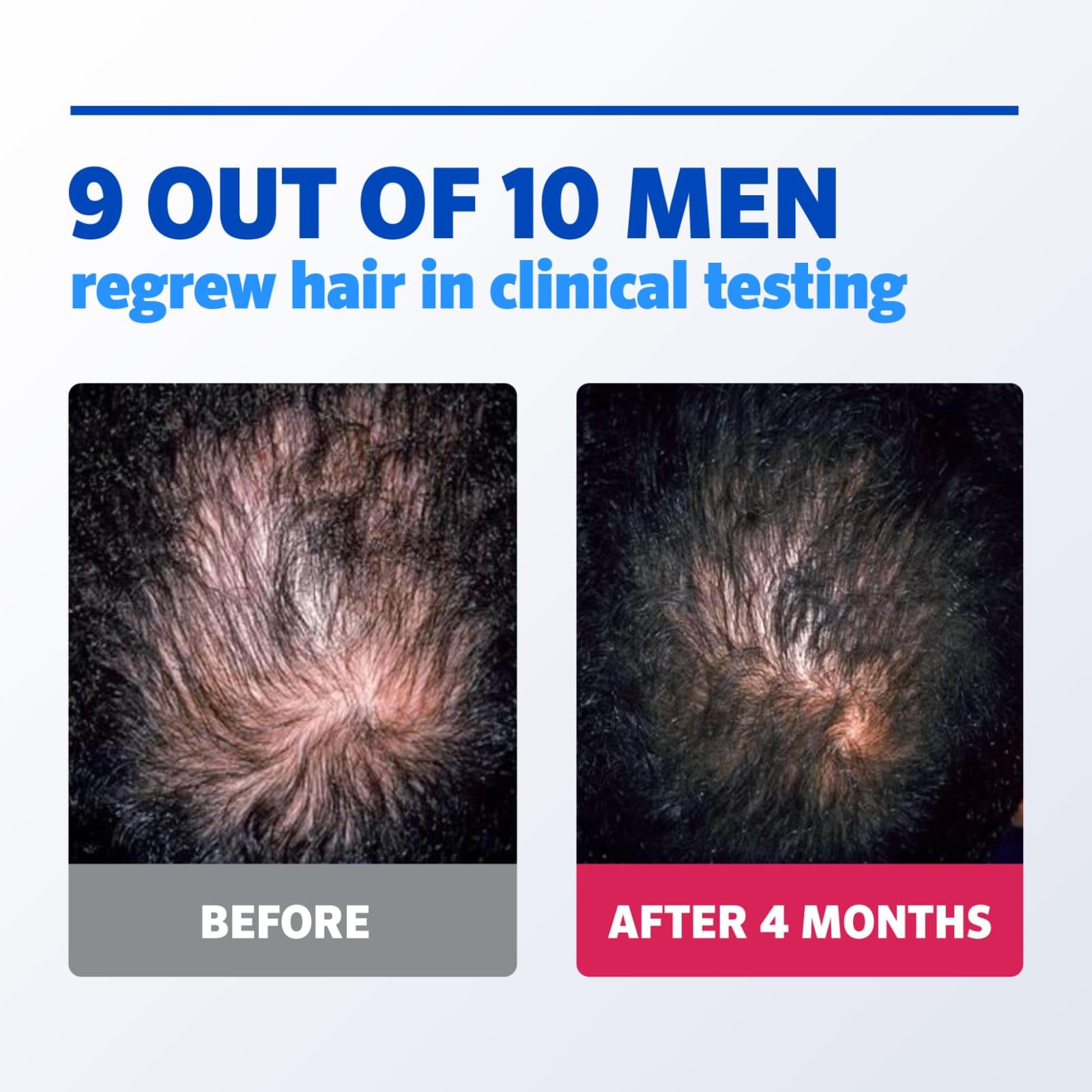 Men’s Rogaine 5% Minoxidil Foam – 3Month Supply - Image 7